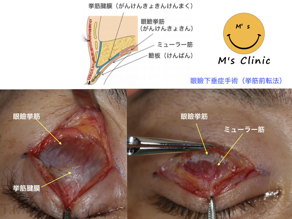 眼瞼下垂症手術　挙筋前転法 v.s.ミューラー筋タッキング法